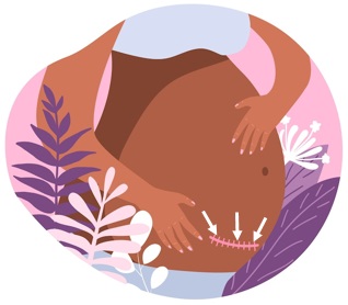 cartoon mage depicting location caesarian section incision 2