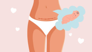how cesarean section affects babies